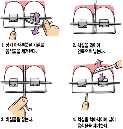 치아교정양치질07.png