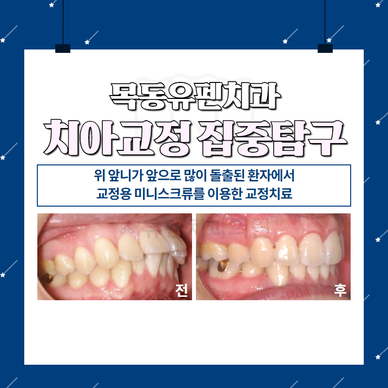 오목교교정치과_유펜치과_돌출된_위_앞니의_교정치료_01.png