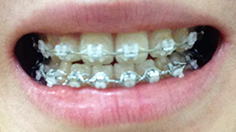 치아교정후기2.jpg