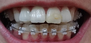 치아교정후기1.jpg
