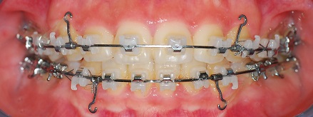 오라픽스 치아 교정 포스팅 사진 (2).jpg