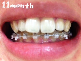 치아교정후기02.JPG