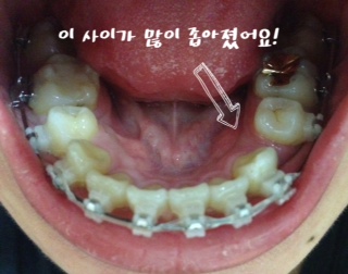 치아교정후기01.JPG