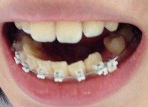 치아교정후기02.JPG