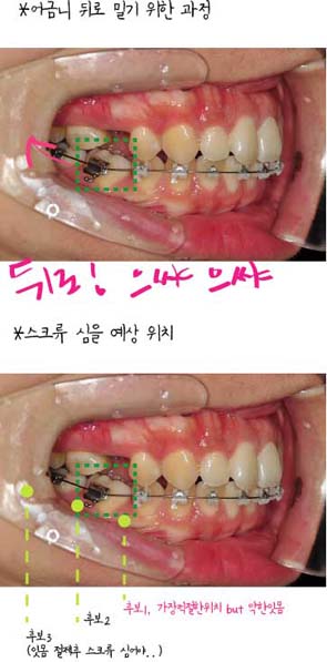 치아교정후기00.jpg