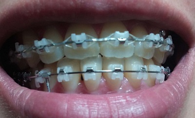 턱관절치아교정후기19화사진2.jpg