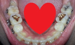 오라픽스 치아교정 포스팅(5).jpg