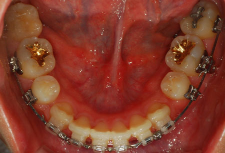 오라픽스 치아 교정 포스팅 (3).jpg