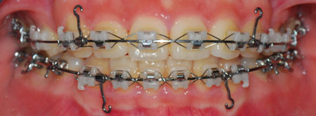 오라픽스 치아 교정 포스팅 (1).jpg