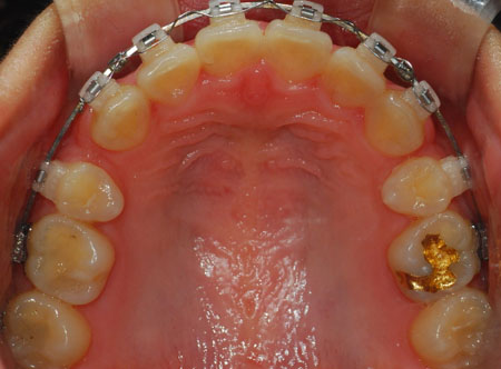 오라픽스 치아 교정 포스팅 (2).jpg