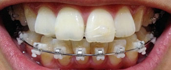 치아교정후기1.jpg