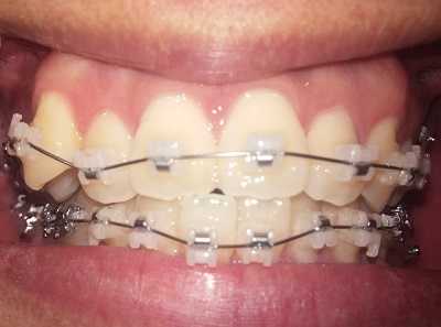 치아교정후기10화사진4.jpg