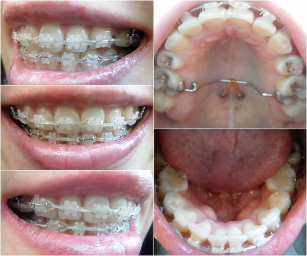 22.킬본교정 (6).jpg