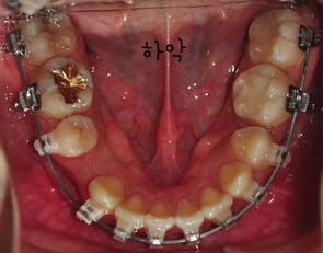 치아교정후기5.jpg