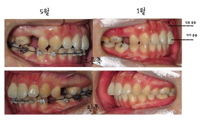 치아교정후기7.jpg