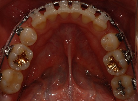 오라픽스 치아교정 포스팅(5).JPG