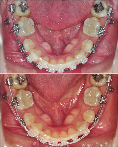 19. 킬본교정 (4).jpg