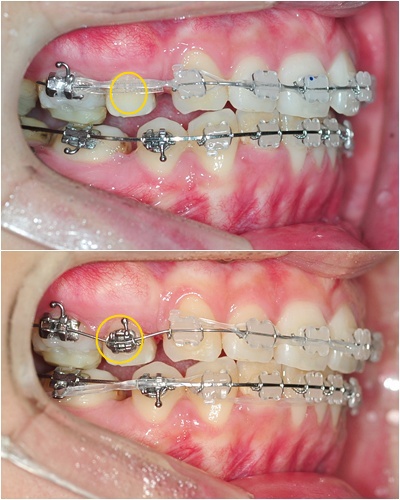 19. 킬본교정 (2).jpg