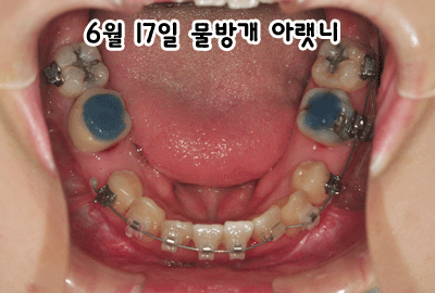 0617-아랫니.gif
