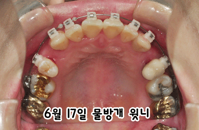 0617-윗니.gif