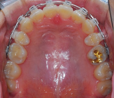 오라픽스 치아교정 포스팅 (7).jpg