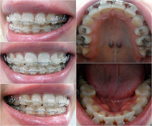 26.킬본교정 (5).jpg