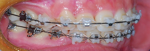 오라픽스 치아교정 포스팅 (6).jpg