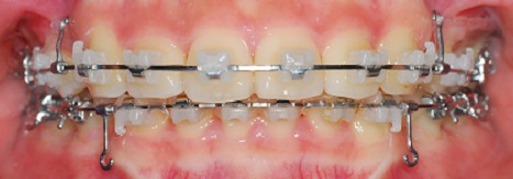 오라픽스 치아교정 포스팅(5).jpg