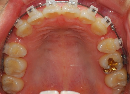 오라픽스 치아교정 포스팅(2).jpg