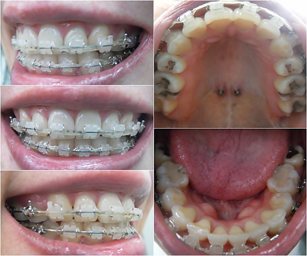 26.킬본교정 (1).jpg