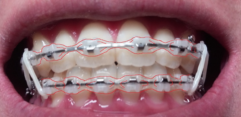 턱관절치아교정후기23화사진1.jpg
