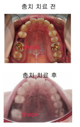치아교정후기2.jpg