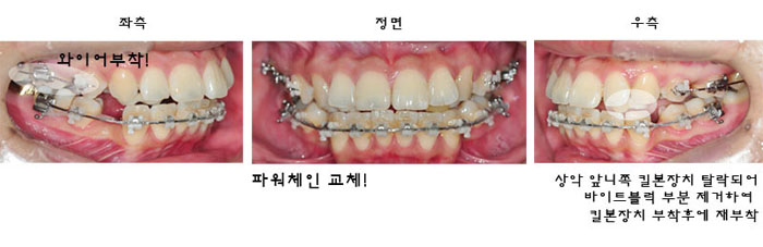 치아교정후기1.jpg