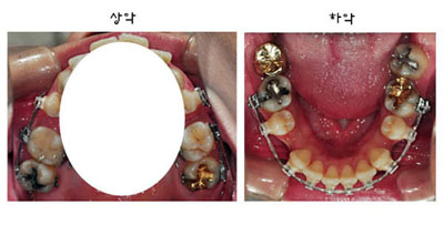 치아교정후기2.jpg
