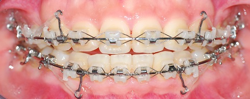 오라픽스 치아교정 포스팅 (7).jpg