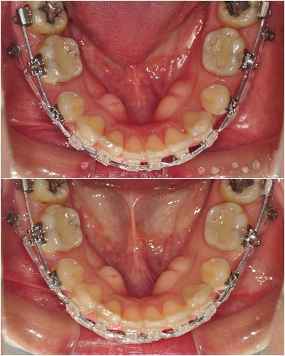 20. 킬본교정.jpg