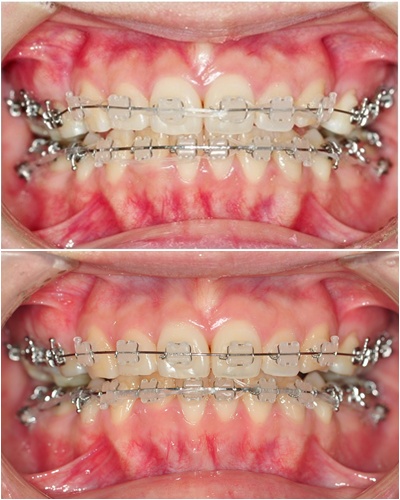 20. 킬본교정 (1).jpg