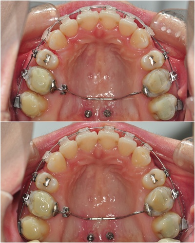 20. 킬본교정 (3).jpg
