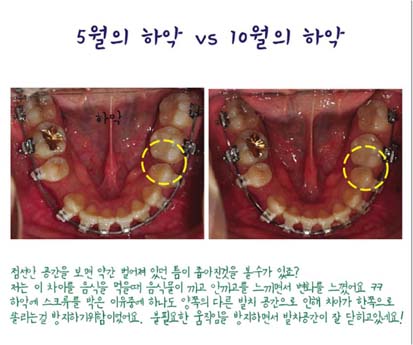 치아교정후기06.jpg