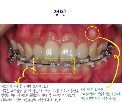 치아교정후기01.jpg