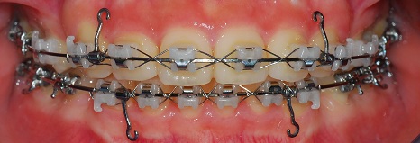 오라픽스 치아교정 포스팅(5).jpg