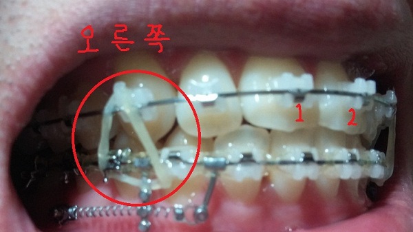 턱관절치아교정후기25화사진9.jpg