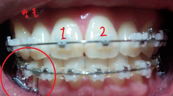 턱관절치아교정후기25화사진4.jpg