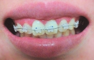 치아교정1.jpg