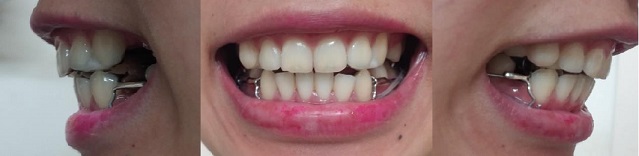 교정후기 12_1.jpg