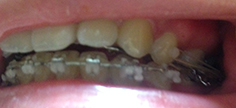 치아교정후기02.JPG