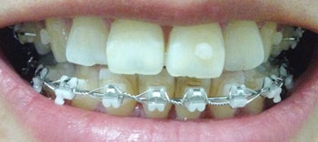 치아교정후기2.jpg
