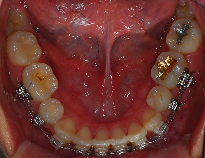 오라픽스 치아교정 포스팅(4).jpg