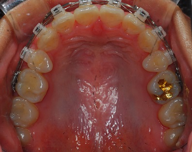 오라픽스 치아교정 포스팅(3).jpg