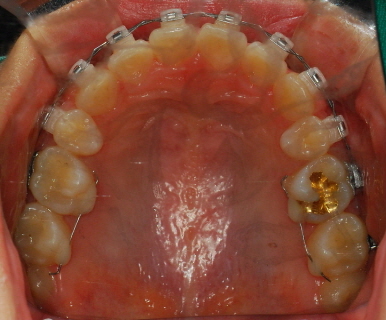 오라픽스 치아교정 포스팅 (9).jpg